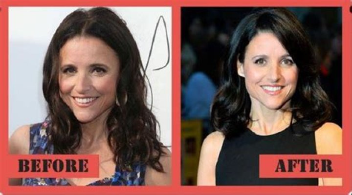 Julia Louis-Dreyfus Botox And Nose Job Before And After Photos